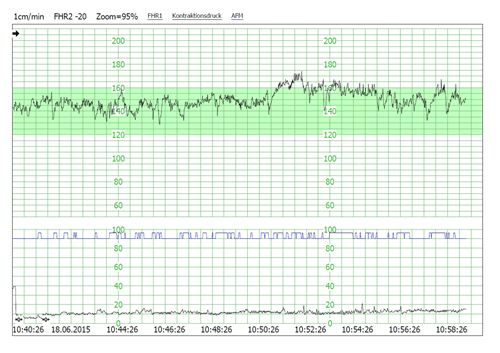 CTG: Schwankungen der Herzfrequenz